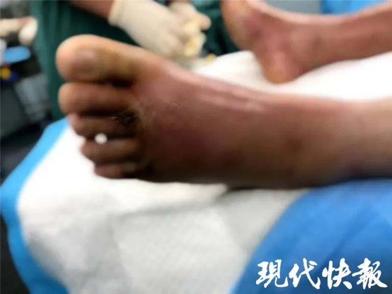 奇才队 男子在家修脚“修出”高危重症，医生连续8次手术