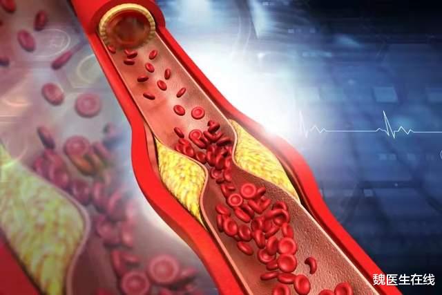 疾病|7个血管堵塞的信号，请不要忽视，8个危险因素要避免