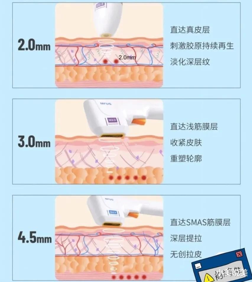 小美说美 超声炮是什么美容项目