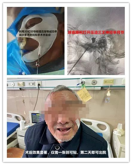 何同学|微创！蚌埠三院神经外科成功完成一例3D打印辅助下三叉神经痛球囊压迫手术