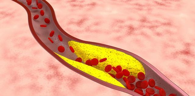 高血压|81岁退休医生提示：身体血脂过高，养成1个好习惯，或可降低血脂