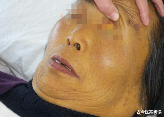 心脏|这个部位长“小红点”,提示肝脏可能出现问题了,建议早查肝ct