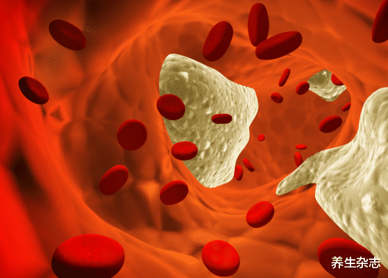 脑梗|血压高的人，多观察手指，若没有2个表现，恭喜，脑梗离你还远