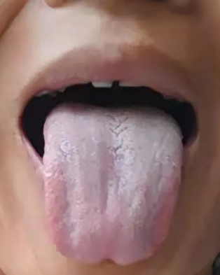 口腔健康|舌象分析：反酸，口干口苦，便溏，胸闷