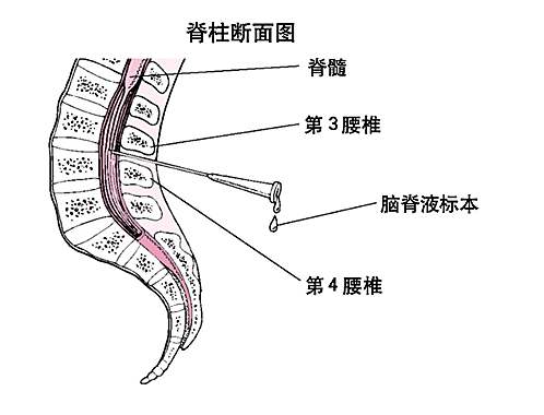 费那那那 儿童做腰穿危险吗?