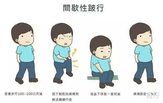 剪刀步|5种怪异步态，暗藏健康危机？