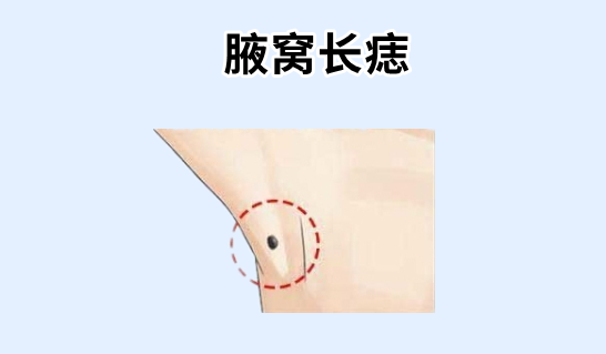 中国易经风水 身上5颗“福禄痣”，有吃有喝，啥也不愁，儿女双全，老了有钱又有福！