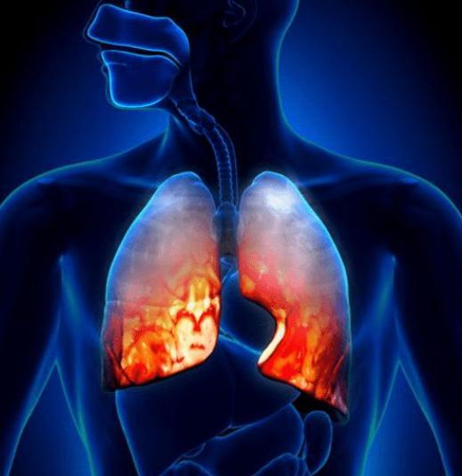 医生|肺结节不能吃虾？医生建议：想养肺，4种食物尽量少吃