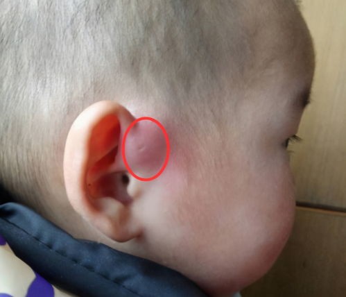 蔷薇妈妈育儿记|新生儿耳朵旁的“小眼”是啥？医生一般不明说，但家长心里要有底