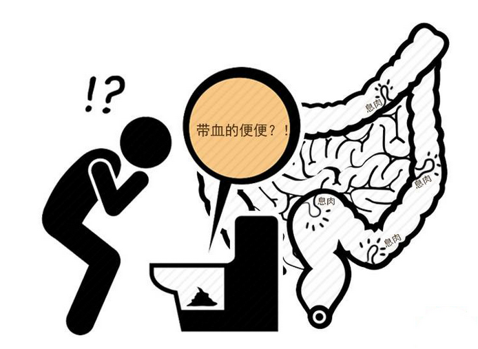 肠癌|肠癌是“养”出来的？医生劝告：身体出现4种症状，越早就医越好