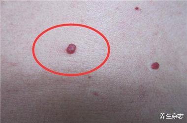 肝脏|一旦身上出现这3种“痣”，十有八九肝脏已病变，尽早做个肝CT