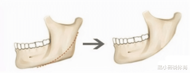 太湖|削骨的明星后悔了吗？后遗症一大堆，小方脸反倒成了真香系列！