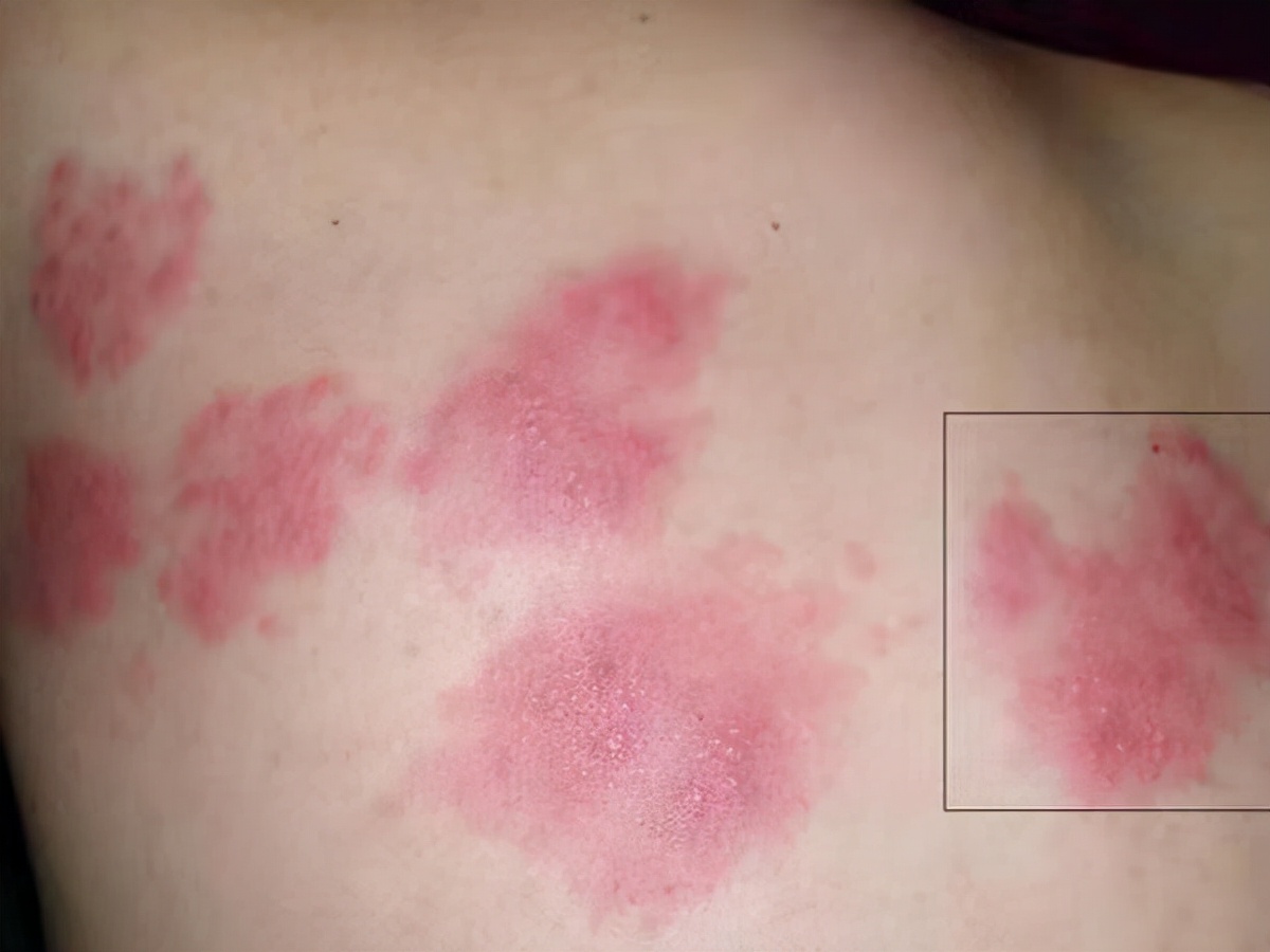 肝癌|肝癌“上身”前1年,往往有发出“求救”信号!医生:奈何没人重视