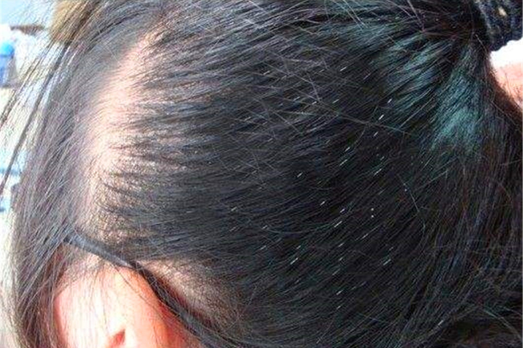 科学家|同人类共进化，30年前人身上常见的虱子，为何如今看不到了？