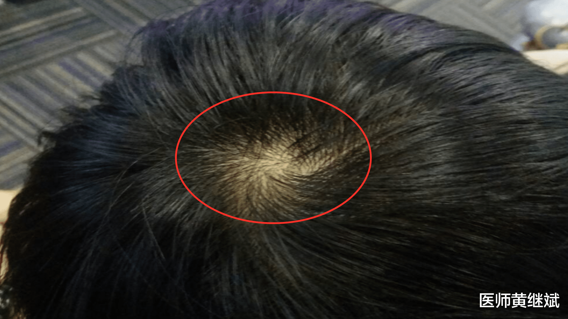 医师黄继斌|不想脱发，不想秃头？一定要管好自己的嘴
