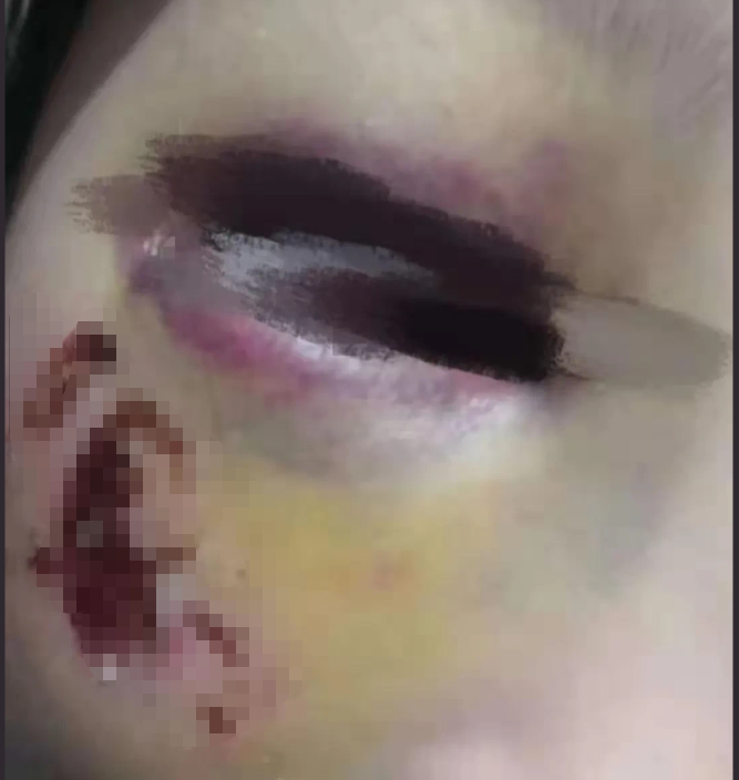 四面观察 8岁女孩做题少写一个单位,被数学老师暴打,眼睛险些失明