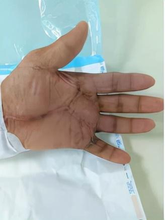 |国庆垂钓注意手卫生一钓客突然烂手久治不愈险废掉