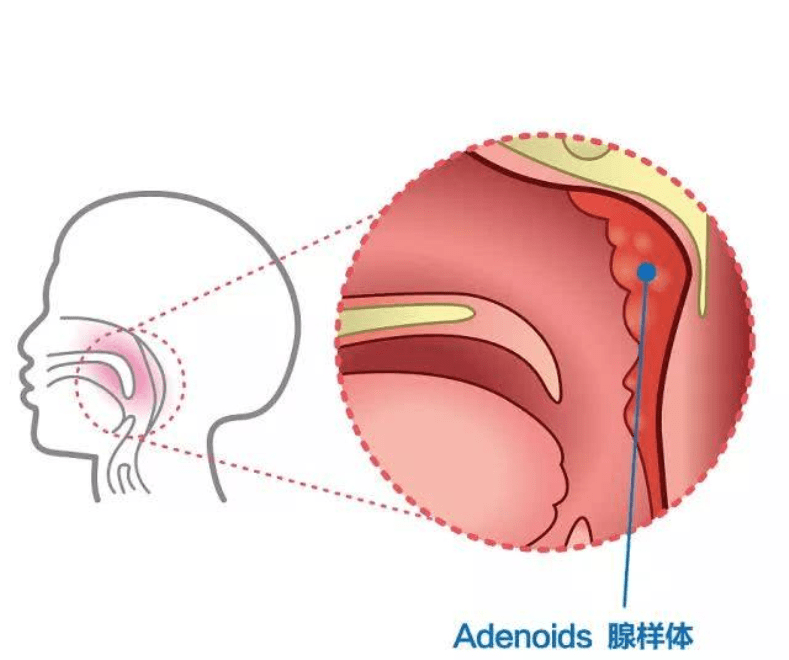 小儿推拿杨晓|小儿推拿杨晓：儿童腺样体肥大越来越多，治腺样体肥大中医有优势