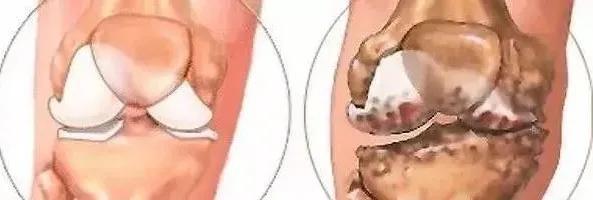 杭吉泰迪干细胞|数百例患者证实:干细胞能修复膝关节损伤!