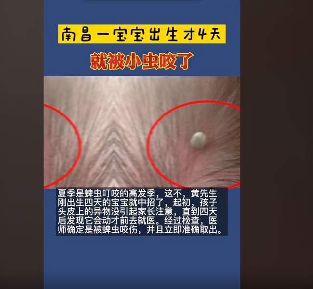 菁妈育儿|孩子被蜱虫咬，霸气爸爸的“三个坚决”救了娃，医生：做得好