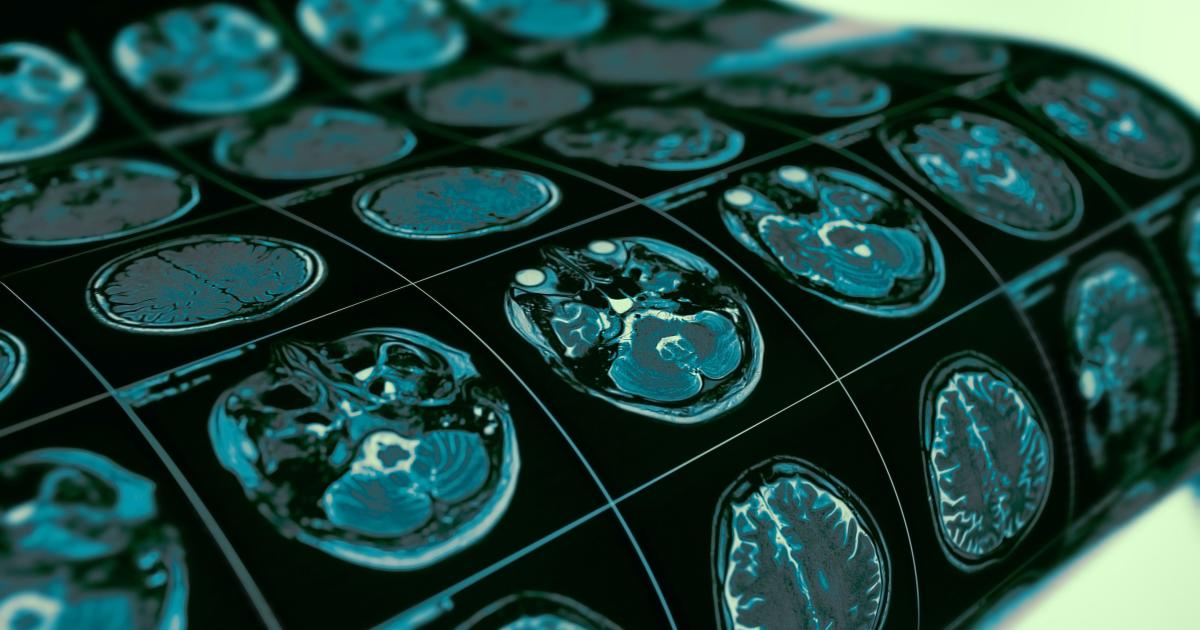 中风|手指发麻，一定是中风吗？医生辟谣：不是所有麻木，都是中风