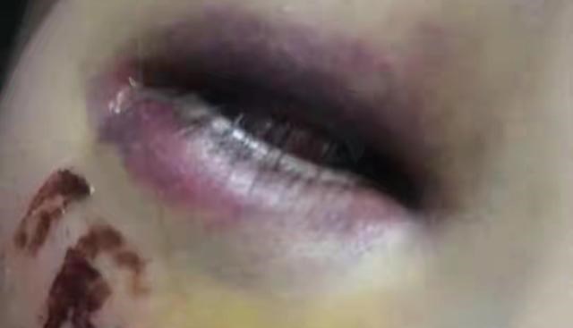 Sasha的运动 一道错题引发的悲剧：二年级女生被老师打伤，险些失明