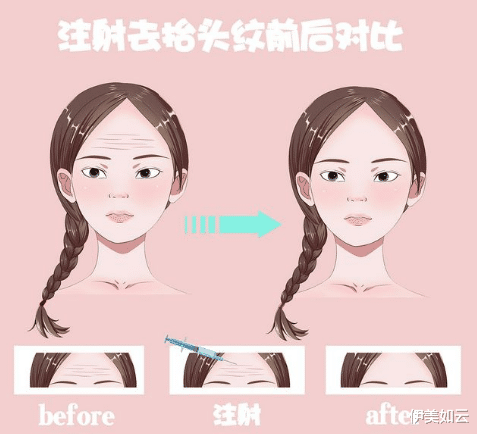 伊美如云|为什么年纪轻轻就出现抬头纹?注意你有没有这些习惯