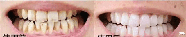 严选 牙黄口臭不用愁,刷牙时放点家家都有的小物,牙齿亮白口气清新