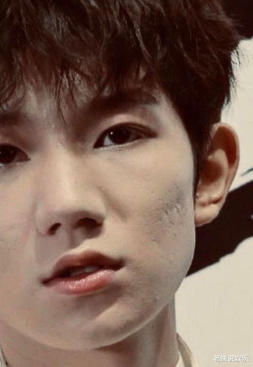 王源|王源 去年夏天青春痘已经让脸变形 现在是否还好?