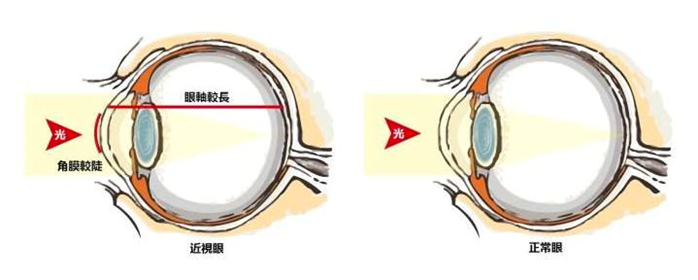 视界沐光VR视力 孩子近视“黄金矫正期”,家长必须要知道!