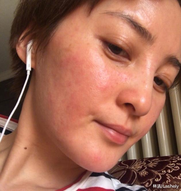 撞脸 蒋勤勤深受过敏困扰撞脸尹正，敏感肌换季保养，分区护肤才是关键