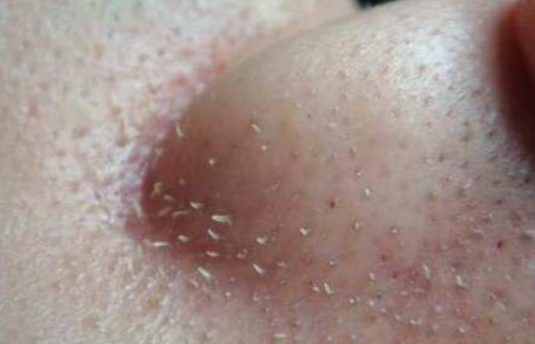 螨虫|鼻子上挤出来的白色条状物，到底是螨虫还是粉刺？很多人都不知情