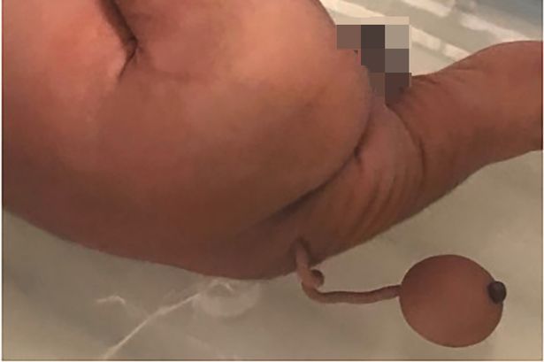 巴西一婴儿出生时竟自带12厘米尾巴,末端还有个肉球