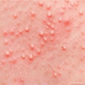 DrKing科学家庭育儿|娃爱长痱子,多少“粉和水”都没用!止痒、消肿,专家支3招!