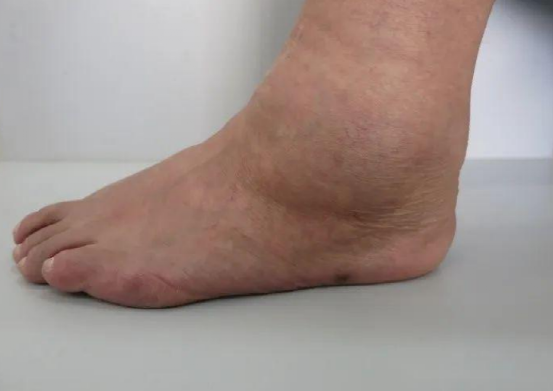 脑梗|脑梗来临，脚先知，提醒：脚部若有3种特征，可能血管已堵死