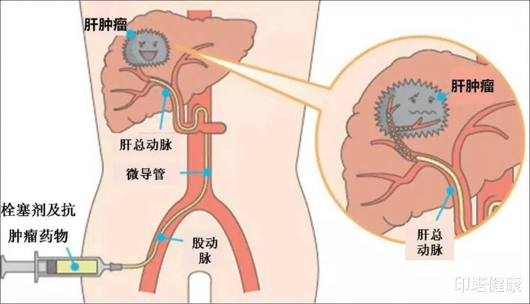 印塔健康|早中期肝癌治疗利器：介入+靶向！显著延长患者生存期