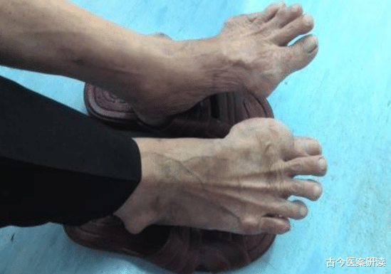 尿酸|尿酸值800能吃鱼？86岁内科院士：想尿酸平稳降，坚持“1多3少”