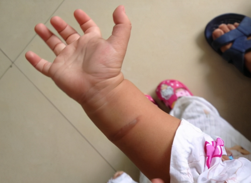 兜妈爱叨叨|孩子被沸水烫伤，家长需谨记五字诀救治，处理不当会害娃