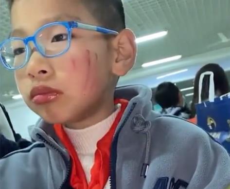 江苏一孩子被抓出三道痕，妈妈心疼得想落泪，网友：结局反转太快