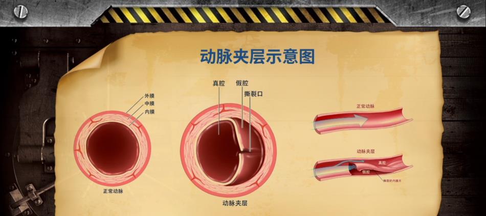 心肌梗塞|39岁男子胸痛12小时，到医院也没救过来！这个病比心梗还凶险