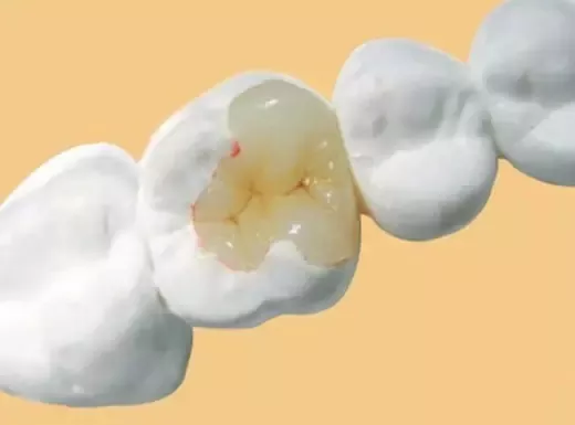 牙齿|常见的补牙材料带你来了解一下~