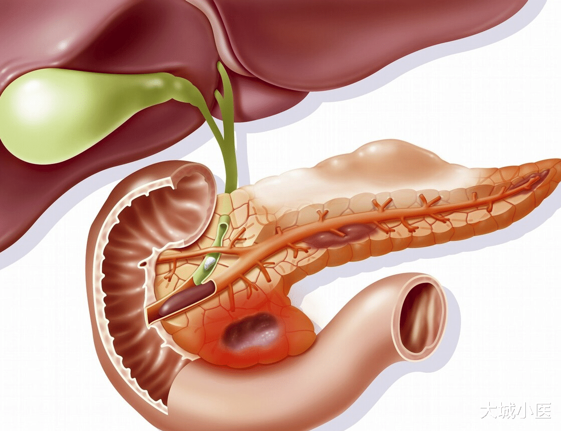 大城小医|急性胰腺炎的病因有哪些？胰腺炎患者日常应该注意些什么？