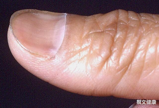 肝脏|平时好端端的，肝为何就被癌症“盯上”？医生提醒：身上有这4个异常，平时多留意，早发现早好