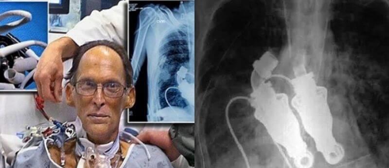 机器|10年前，全球首位无心人出现，没有心跳脉搏，机器停止就死亡