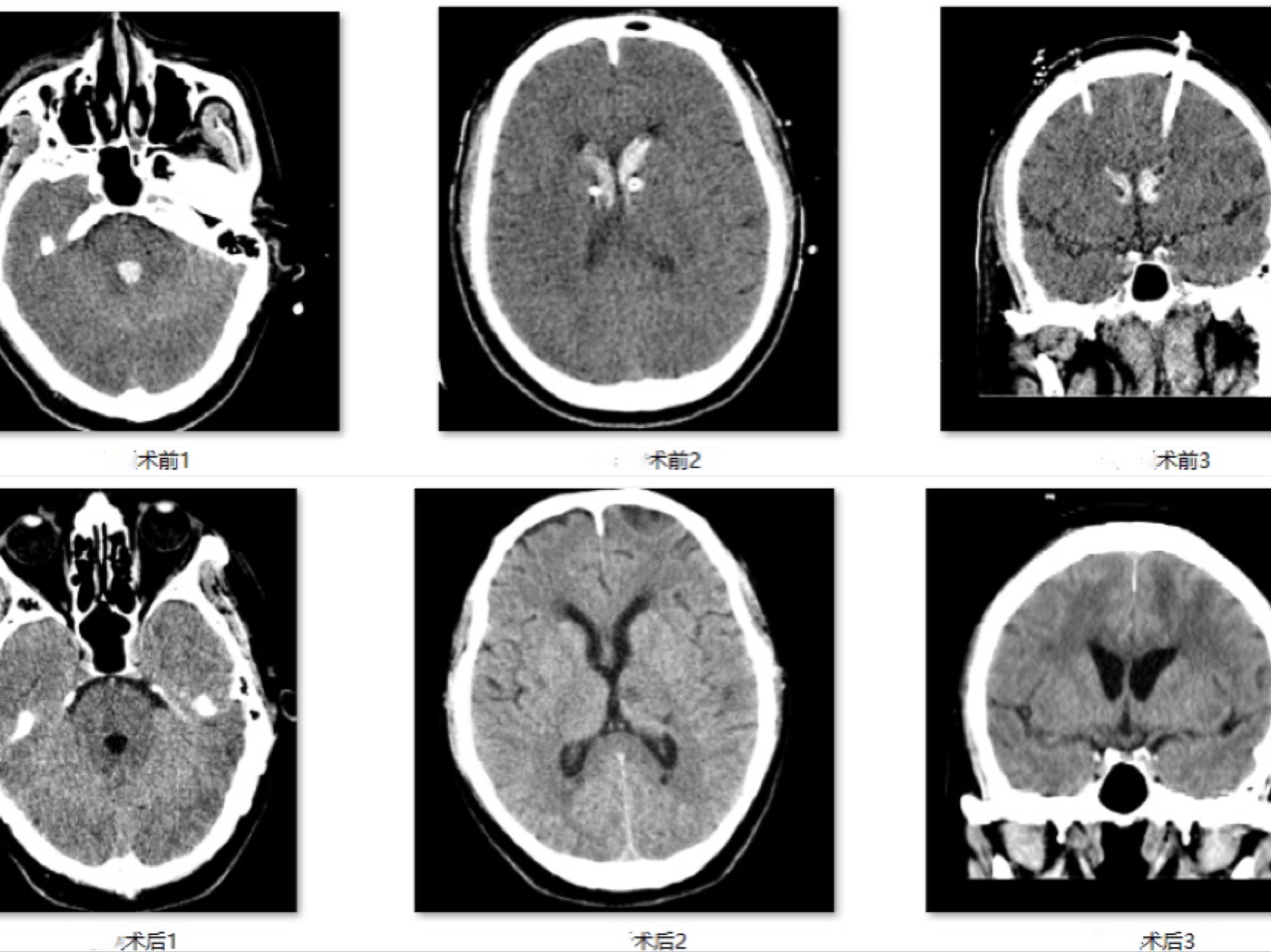 费那那那 肖庆病例分享：脑出血倒地18小时, 内镜下17分钟挽回生命
