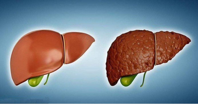 雪雪的鱼|36岁女子查出肝癌,医生叹息:煮汤常放“一物”,铁打的肝也受不了!