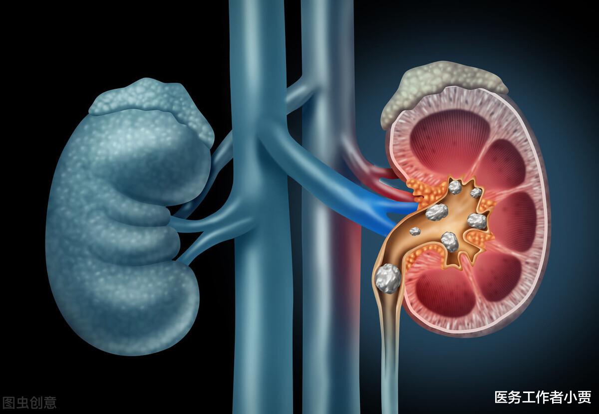 运动|得了肾结石后，怎么才能更快的恢复身体？请看此文