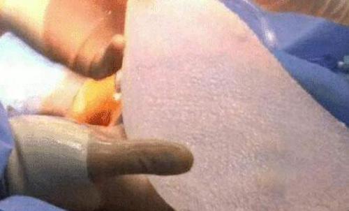 舜网 那个花了100万植入翅膀的女子，现在真的能飞了吗？