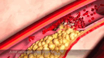 景焕粒子能|粒子能细胞康复液可修复损伤的血管,预防动脉粥样硬化!