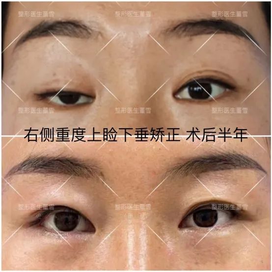 墨鱼|董雪:上睑下垂修复手术的坑有多深?丨科普篇